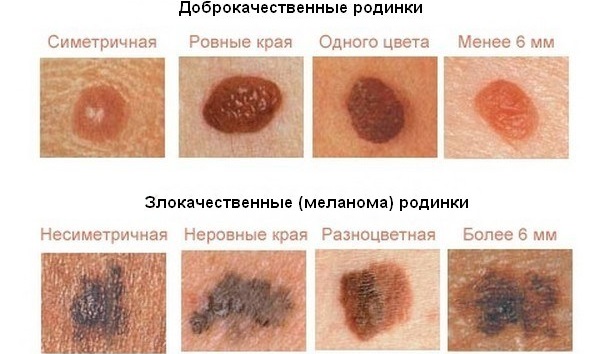Cách tẩy nốt ruồi trên mặt bằng thẩm mỹ, phương pháp tại nhà