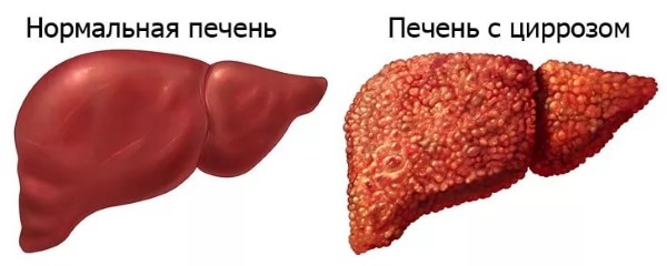 Како уклонити велики стомак код жена и мушкараца. Узроци и лекови