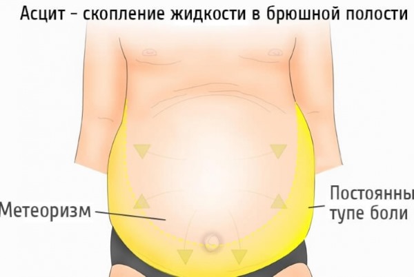Како уклонити велики стомак код жена и мушкараца. Узроци и лекови