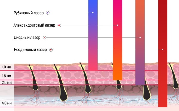 Tẩy lông bằng laser. Nó có hại cho sức khỏe không, đánh giá của bác sĩ, chống chỉ định và hậu quả. Bạn có thể làm bao lâu một lần