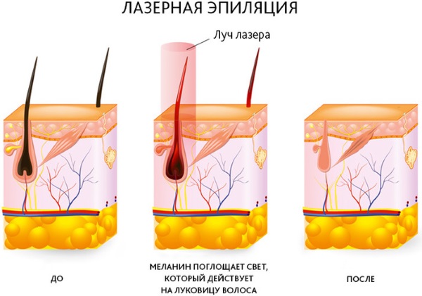 Tẩy lông bằng laser. Nó có hại cho sức khỏe không, đánh giá của bác sĩ, chống chỉ định và hậu quả. Bạn có thể làm bao lâu một lần