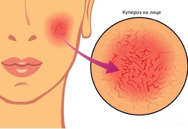 Pembuangan laser pembuluh darah di wajah dengan laser neodymium, flash, elos. sebelum dan selepas gambar, ulasan