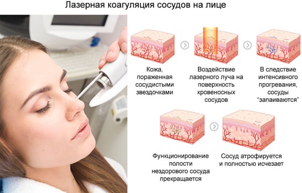 Pembuangan laser pembuluh darah di wajah dengan laser neodymium, flash, elos. sebelum dan selepas gambar, ulasan
