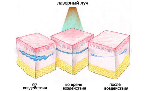Pembuangan laser pembuluh darah di wajah dengan laser neodymium, flash, elos. sebelum dan selepas gambar, ulasan