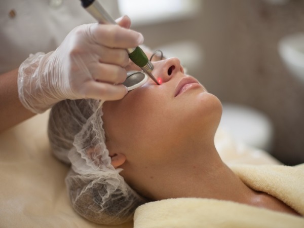 Pembuangan laser pembuluh darah di wajah dengan laser neodymium, flash, elos. sebelum dan selepas gambar, ulasan