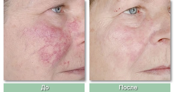Pembuangan laser pembuluh darah di wajah dengan laser neodymium, flash, elos. sebelum dan selepas gambar, ulasan