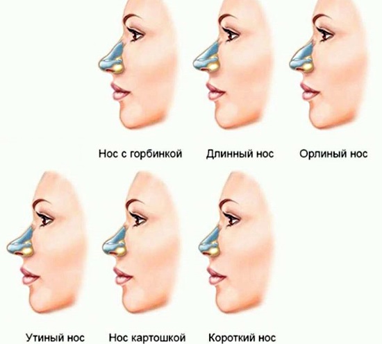 Cách sửa mũi cho nữ bằng khoai tây. Nâng mũi, hình ảnh trước và sau phẫu thuật, giá cả