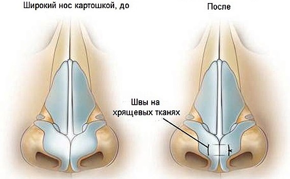 Cách sửa mũi cho nữ bằng khoai tây. Nâng mũi, hình ảnh trước và sau phẫu thuật, giá cả