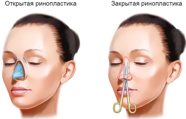 Cách sửa mũi cho nữ bằng khoai tây. Nâng mũi, hình ảnh trước và sau phẫu thuật, giá cả