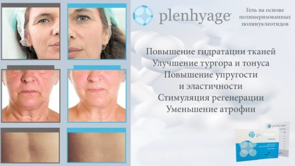 Полинуклеотиди у ињекционој козметологији.Припреме, цене, где купити