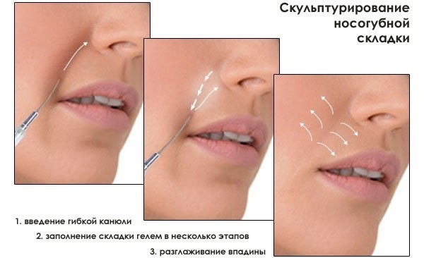 Radiesse في التجميل. مراجعات لأخصائيي التجميل ، موانع الاستعمال ، العواقب