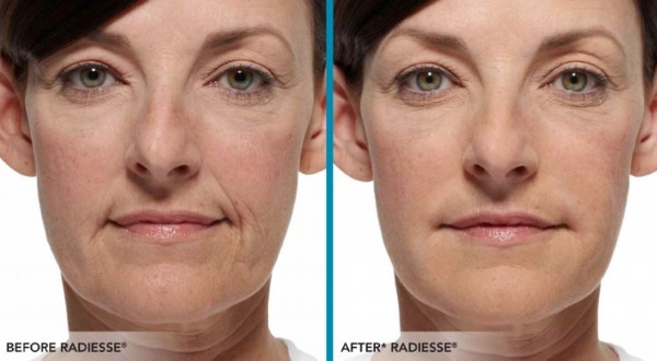 Radiesse في التجميل. مراجعات لأخصائيي التجميل ، موانع الاستعمال ، العواقب