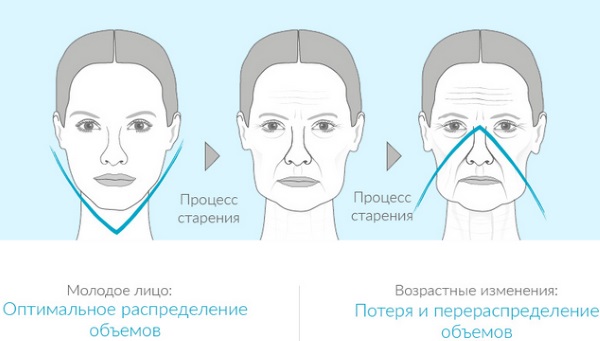 Radiesse في التجميل. مراجعات لأخصائيي التجميل ، موانع الاستعمال ، العواقب