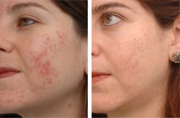 مرهم الزنك للوجه ضد التجاعيد في التجميل. ما الذي يساعد وكيفية استخدامه