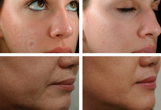 Mesoterapia facial fraccionada: indicaciones, resultados, efectos secundarios, consecuencias. Reseñas