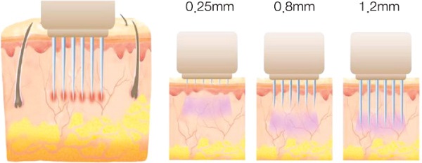 Mesoterapia facial fraccionada: indicaciones, resultados, efectos secundarios, consecuencias. Reseñas