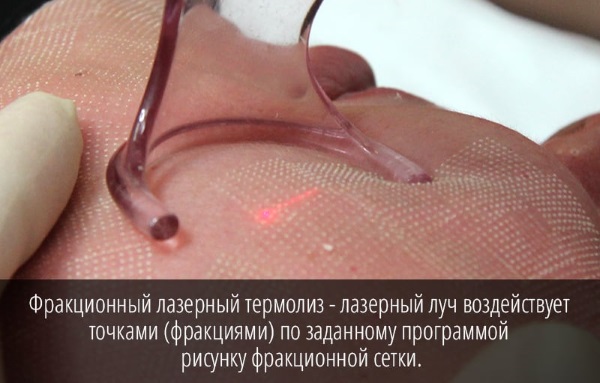 Quang nhiệt phân đoạn. Quy trình này là gì, tác dụng, nó được thực hiện như thế nào, trước và sau khi chụp ảnh, đánh giá, giá cả