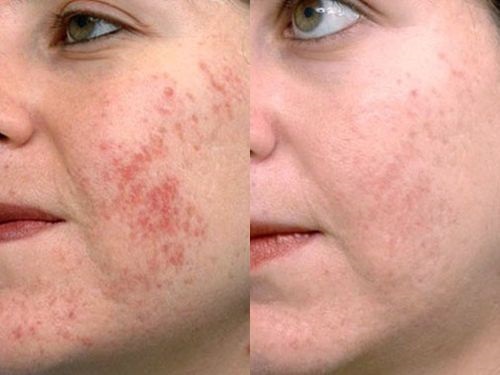 Quang nhiệt phân đoạn. Quy trình này là gì, tác dụng, nó được thực hiện như thế nào, trước và sau khi chụp ảnh, đánh giá, giá cả