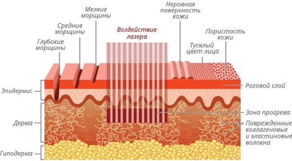 Quang nhiệt phân đoạn.Quy trình này là gì, tác dụng, nó được thực hiện như thế nào, trước và sau khi chụp ảnh, đánh giá, giá cả