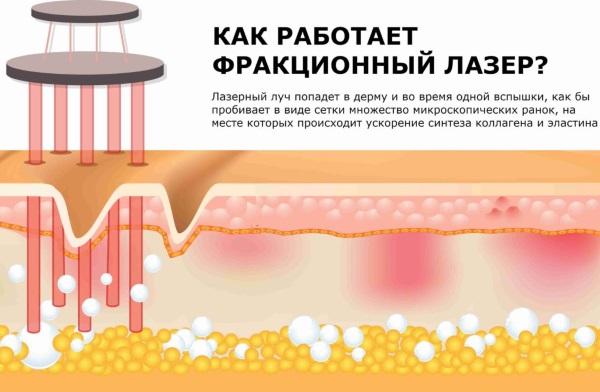 Quang nhiệt phân đoạn. Quy trình này là gì, tác dụng, nó được thực hiện như thế nào, trước và sau khi chụp ảnh, đánh giá, giá cả