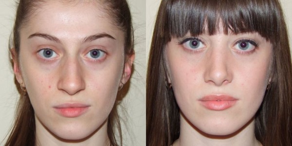 Rejuvenescimento facial de plasma. Tipos de procedimentos, dispositivos, fotos antes e depois, avaliações