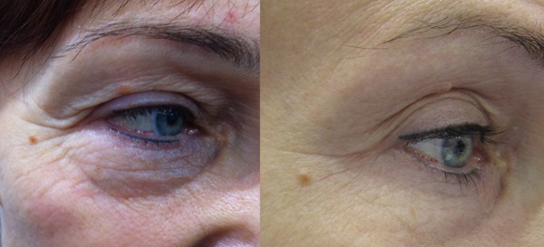 Rejuvenescimento facial de plasma. Tipos de procedimentos, dispositivos, fotos antes e depois, avaliações