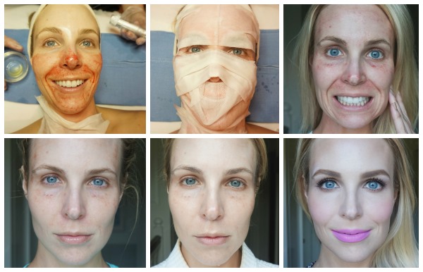 Rejuvenescimento facial de plasma. Tipos de procedimentos, dispositivos, fotos antes e depois, avaliações