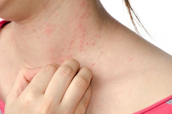Natri benzoat trong mỹ phẩm. Nó là gì, lợi ích và tác hại, thành phần của chất bảo quản, triệu chứng quá liều