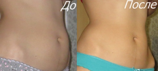 Massage bụng chống cellulite. Cách thực hiện, video hướng dẫn chuyên nghiệp, ảnh trước và sau
