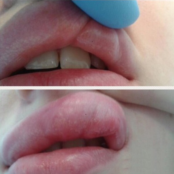 Kesan Tyndall dalam kosmetologi di bawah mata, pada kulit bibir. Apabila diperhatikan cara membuang