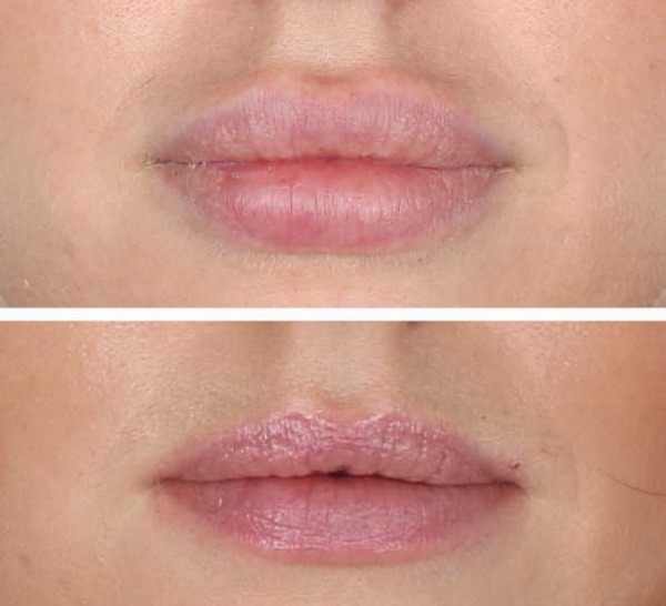 Kesan Tyndall dalam kosmetologi di bawah mata, pada kulit bibir. Apabila diperhatikan cara membuang