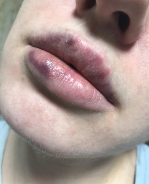 Kesan Tyndall dalam kosmetologi di bawah mata, pada kulit bibir. Apabila diperhatikan cara membuang