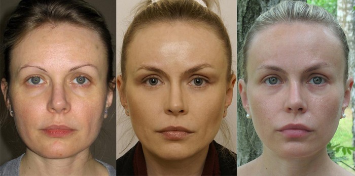 Endoscopia para levantamento de testa e sobrancelha. Fotos antes e depois, como é feito, consequências, avaliações