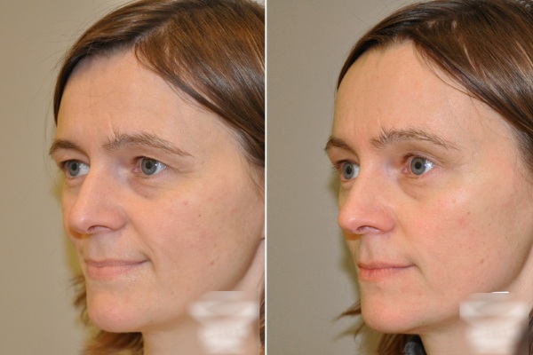 Endoscopia para levantamento de testa e sobrancelha. Fotos antes e depois, como é feito, consequências, avaliações