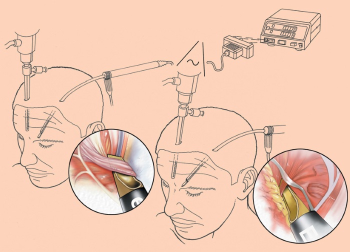 Endoscopia para levantamento de testa e sobrancelha. Fotos antes e depois, como é feito, consequências, avaliações