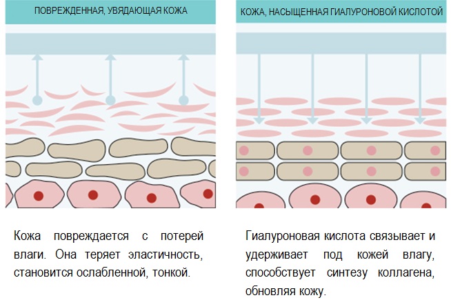 Endoscopia para levantamento de testa e sobrancelha. Fotos antes e depois, como é feito, consequências, avaliações