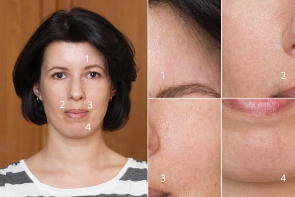 Terapi laser Fraxel untuk kulit wajah. Petunjuk, sebelum dan selepas gambar, ulasan