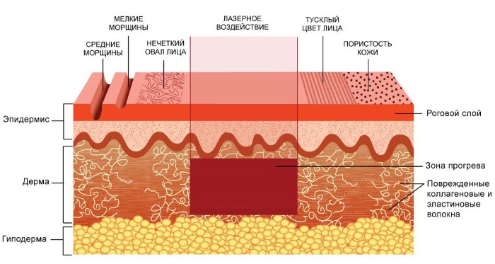 Terapi laser Fraxel untuk kulit wajah. Petunjuk, sebelum dan selepas gambar, ulasan