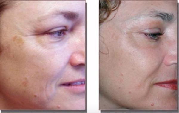 Terapi laser Fraxel untuk kulit wajah. Petunjuk, sebelum dan selepas gambar, ulasan