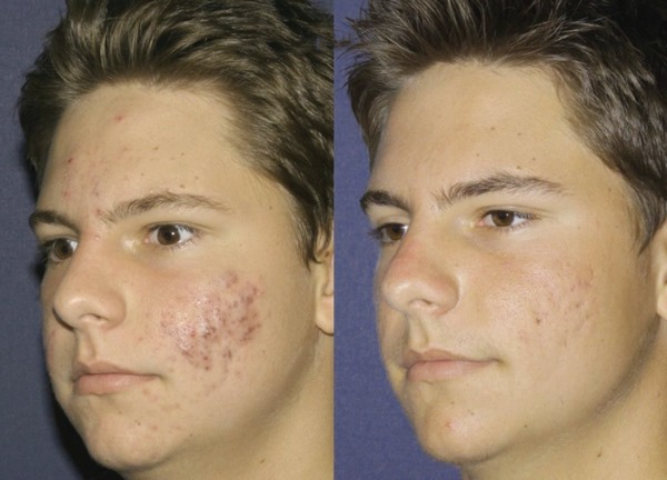 Terapi laser Fraxel untuk kulit wajah. Petunjuk, sebelum dan selepas gambar, ulasan
