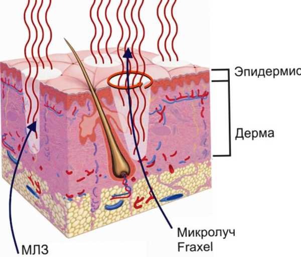Terapi laser Fraxel untuk kulit wajah. Petunjuk, sebelum dan selepas gambar, ulasan
