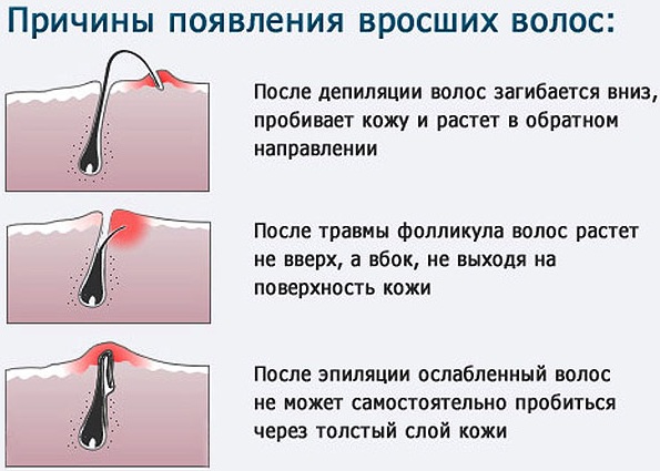 Уклањање длака у дубоком бикини пределу. Шугаринг, ласерско уклањање длака, депилација воском, фотоепилација, електролиза, биоепилација