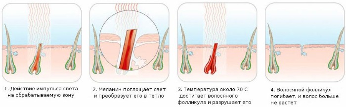 Уклањање длака у дубоком бикини пределу. Шугаринг, ласерско уклањање длака, депилација воском, фотоепилација, електролиза, биоепилација