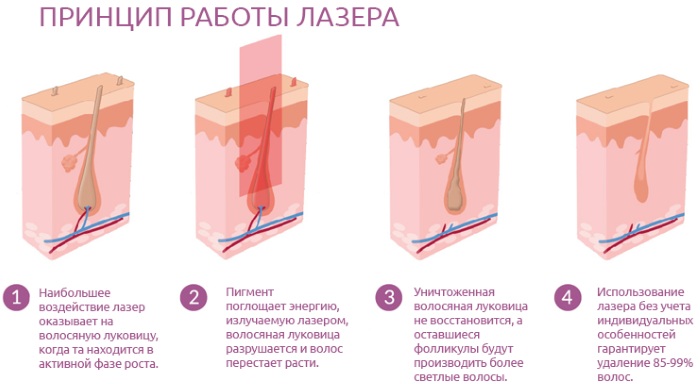 Уклањање длака у дубоком бикини пределу. Шугаринг, ласерско уклањање длака, депилација воском, фотоепилација, електролиза, биоепилација