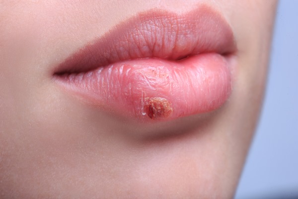 Cara menjadikan bibir lebih besar tanpa pembedahan menggunakan solek, botol, senaman di rumah