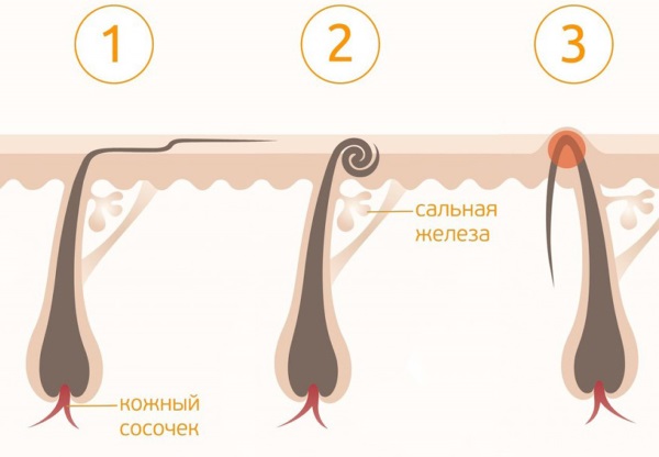 Како се трајно отарасити длака на телу. Народни лекови, козметички поступци