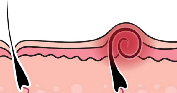 Cara menghilangkan rambut yang tumbuh ke dalam pada kaki, muka, badan selepas penyusutan, shugaring