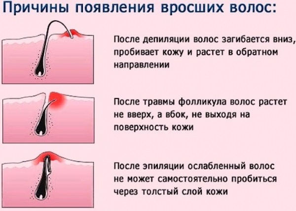 Cara menghilangkan rambut yang tumbuh ke dalam pada kaki, muka, badan selepas penyusutan, shugaring