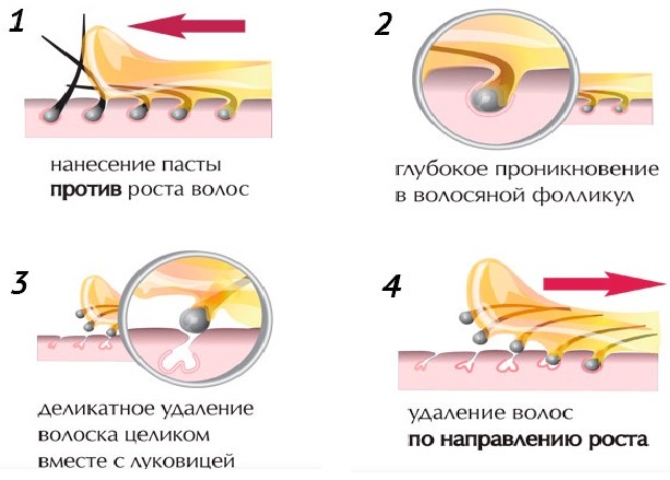 Уклањање длака у дубоком бикини пределу. Шугаринг, ласерско уклањање длака, депилација воском, фотоепилација, електролиза, биоепилација