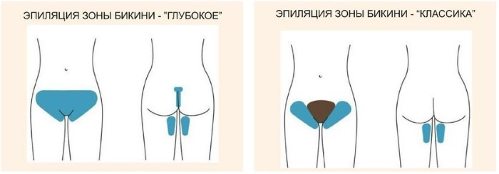 Уклањање длака у дубоком бикини пределу. Шугаринг, ласерско уклањање длака, депилација воском, фотоепилација, електролиза, биоепилација
